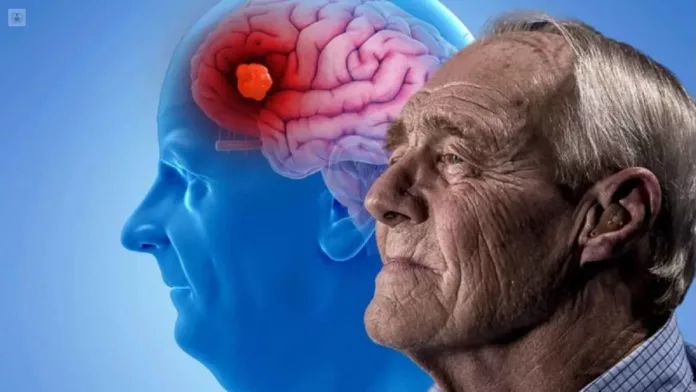 Un nuevo fármaco mostró resultados alentadores contra el Alzheimer